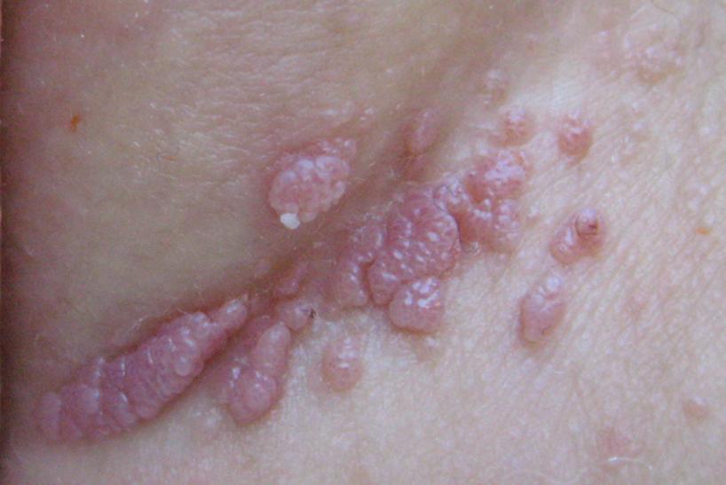 papilloma virus e herpes