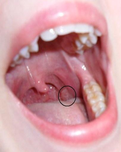 human papillomavirus in mouth symptoms
