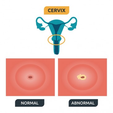 Development Process of Transformation Zone and Cervical Cancer (cervical cancer)