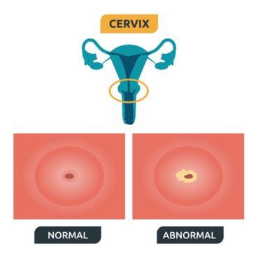 Transformasyon Zonu ve Rahim Ağzı Kanseri (serviks Kanseri) Gelişme Süreci