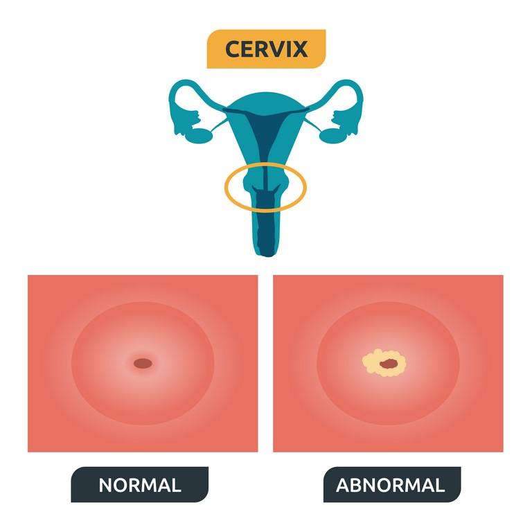 Development Process of Transformation Zone and Cervical Cancer (cervical cancer)