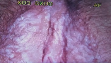 Colcospcopy of Vulva
