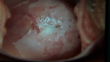What Are Abnormal Colposcopy Findings?