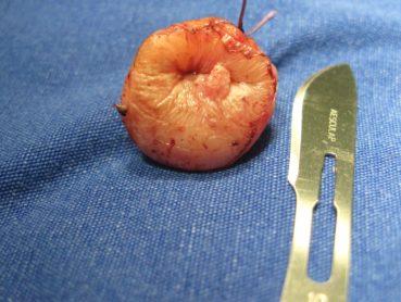 CIN veya LSIL / HSIL Tedavisi Nasıl Yapılır? Konizasyon, Ablasyon ve Histerektomi