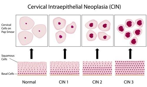 Cin 4 papilloma, HPV genotipare în leziune/raclat (regiunea anogenitală și orală)