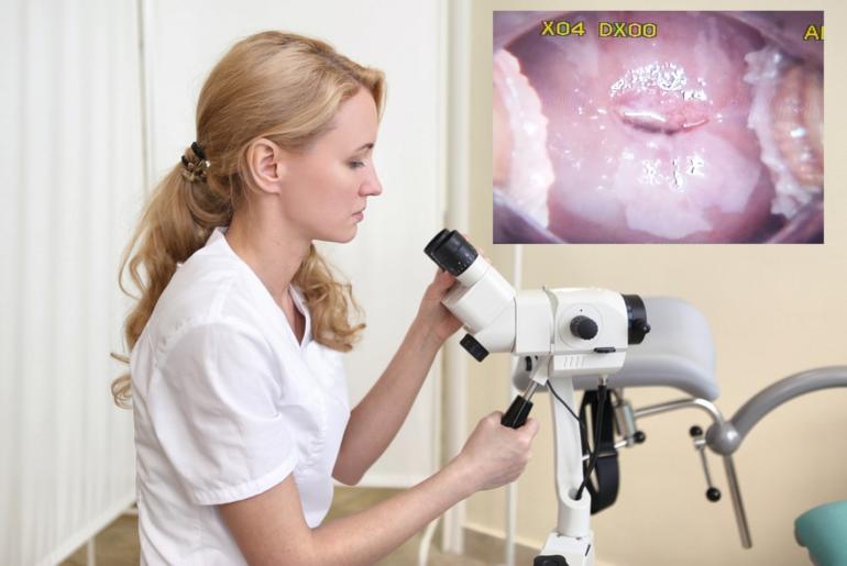 What Is Colposcopy ? How Is It Performed?