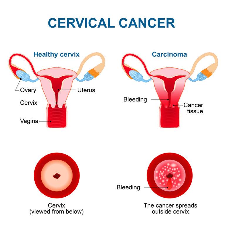 Cervical Cancer Indications Cervical Cancer Indications