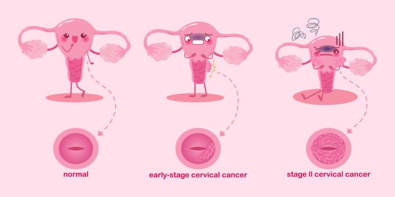 Risk Factors for Cervical Cancer 1
