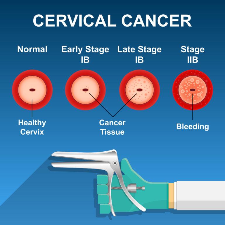 Risk Factors for Cervical Cancer 2
