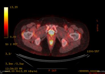 Rahim Ağzı Kanseri Tanı Yöntemleri