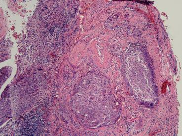 Rahim Ağzı Kanseri (Serviks Kanseri) nin Hücresel Tipleri Nelerdir? Aralarında Ne Fark Vardır?