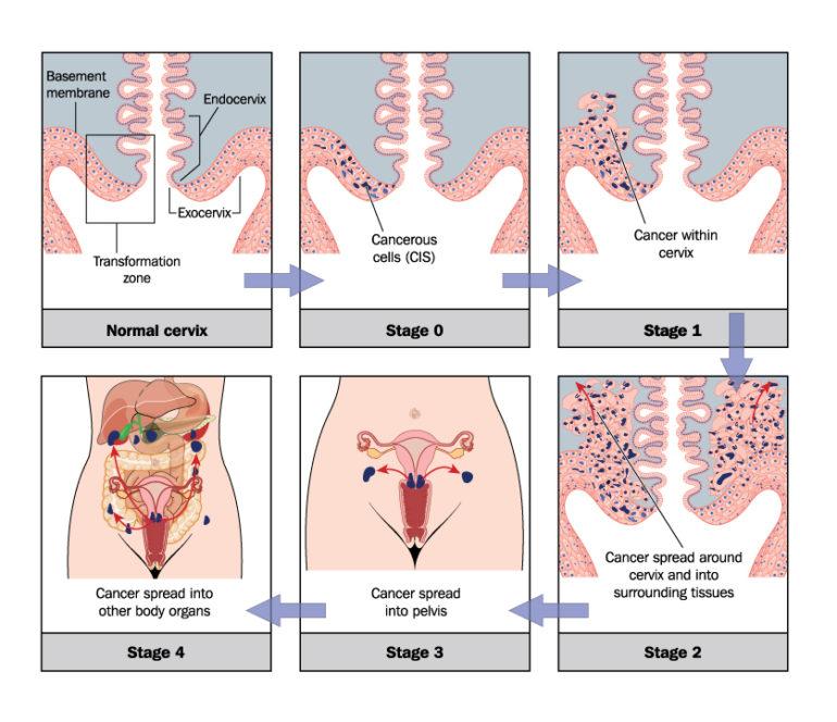 Cervical Cancer Current Staging